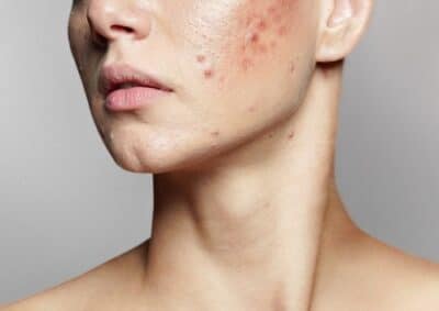 پوست آکنهای